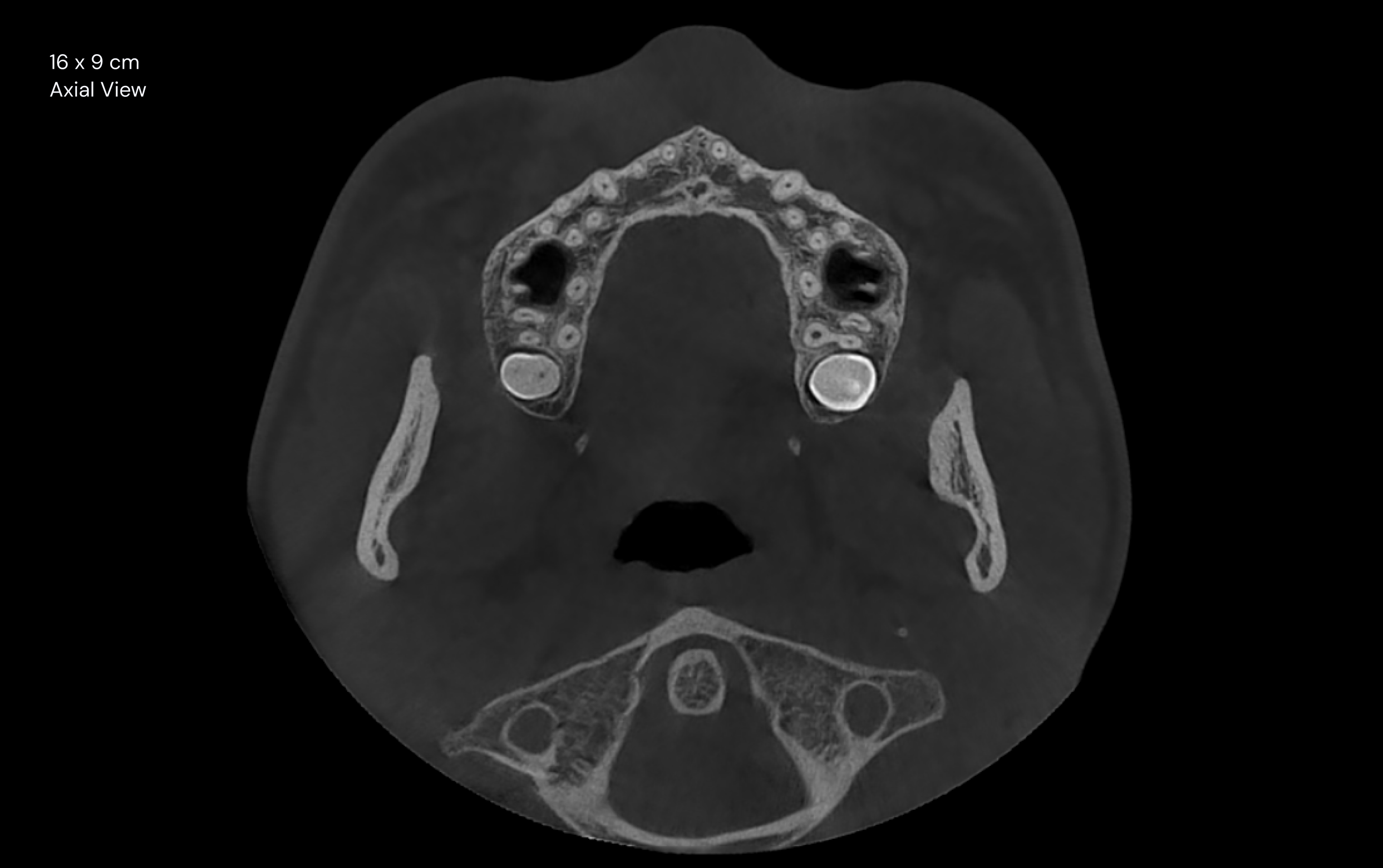 16 x 9 cm Axial View